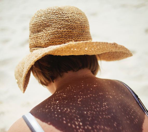 Protection from sunbathing by shading yourself with sunscreen and a sun hat